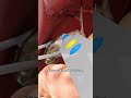 Gallbladder removal surgery - Open Cholecystectomy #shorts - creativelearning3d