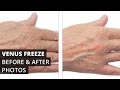 Venus Freeze™ Before & After Photos