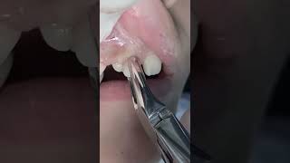 Extraction of deciduous tooth ( A ) #dentistry