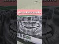 ตัวอย่างฟิล์ม เอกซเรย์ฟัน คลินิกทําฟันประชาอุทิศ90 ยิ้มพิมพ์ใจ ถอนฟัน ถอนฟันคุด ฟันคุด