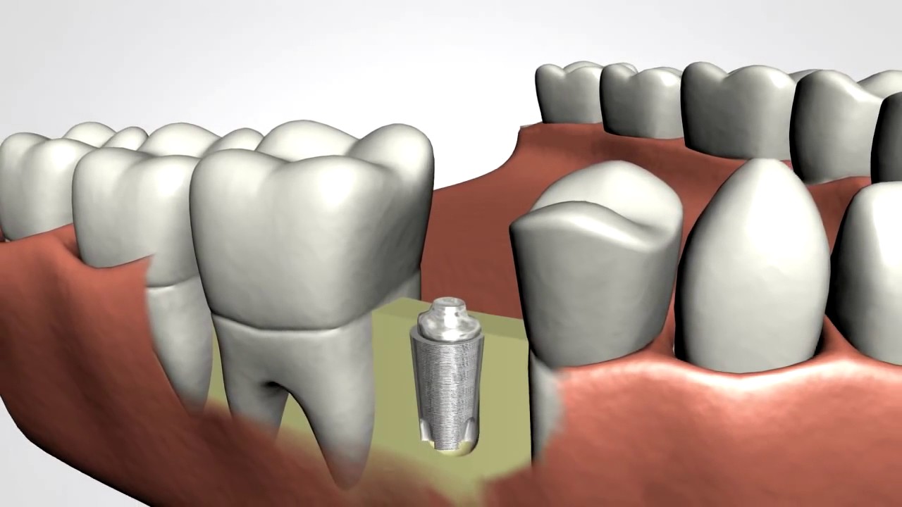 Dental Implants Youtube