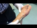 Removing Fixation Wires 3 Weeks After Bunion Surgery