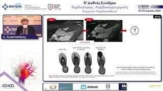 Υπερτροφική μυοκαρδιοπάθεια παιδικής ηλικίας | Άρης Αναστασάκης
