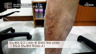 삶의 질을 떨어트리고 전신 건강을 위협하는 당뇨병 TV CHOSUN 230125 방송  | [인생의 연장전] 27회 | TV조선