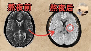 【最新科研】一夜不睡覺，大腦老兩歲｜熬夜的危害｜恐怖的睡眠剝奪實驗｜長期睡眠不足的後果｜阿川是個好人