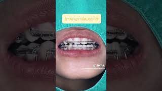 รีเทนเนอร์มีกลิตเตอร์ #จัดฟัน #รีเทนเนอร์ #softandsmiledentalclinic