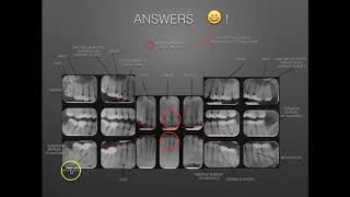 The Full Mouth X-ray Survey Identification & Film Mounting