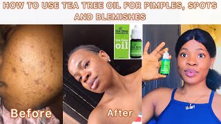 HOW TO TREAT ACNE - REMOVE PIMPLES and Blemishes + Tea tree oil for acne