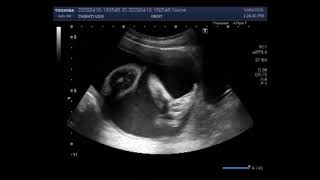 Ultrasound Video showing the case of Anencephaly.