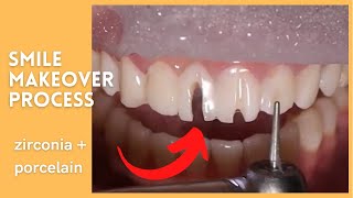 Zirconia and porcelain smile makeover procedure, how it’s done