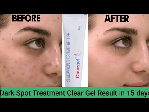 Clindamycin Clear Gel For Dark Spot & Acne Scars || Effective For All ...