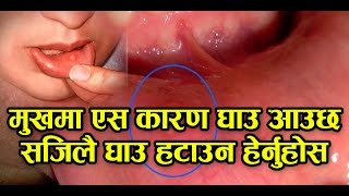 मुखमा र जिब्रोमा खटिरा आयो ?  सजिलै हटाउन यो भिडियो हेर्नुहोस |Health Tips