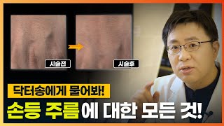 손등주름치료/손등주름완전정복/손등주름펴는방법/손등주름제거