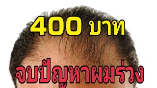 จบปัญหาผมร่วงด้วยเงิน 400 บาท ไม่ต้องจ่ายแพง