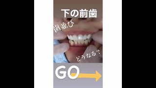 下の歯並びどうなる？ダイヤモンド今井院長のセラミック矯正