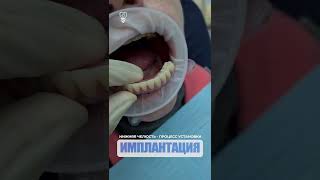 Нижняя челюсть - процесс установки. Lower jaw - the installation process. Implantation.