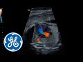 Voluson S10 | GE Healthcare