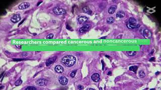 Loss of PTEN expression causes metabolic reprogramming in hepatocellular carcinoma