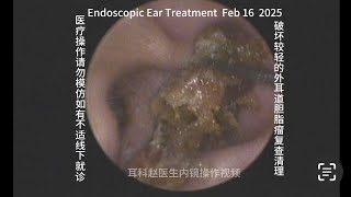 Re examination and cleaning of less severely damaged external auditory canal cholesteatoma 20250216