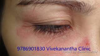 அலர்ஜி- அர்ட்டிகேரியா-  Urticaria Allergy Skin Problems  Treatment