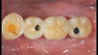 Posterior restoration using bite impression procedure