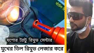 তিল রিমুভ / Mole Remove / তিল রিমুভ লেজার ট্রিটমেন্ট / laser mole removal/ jessore