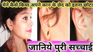 Ear Hole Treatment in Hindi कान के छेद को छोटा करने के आसान उपाय Kaan Ke Ched Ka Ilaj #Shalu #Earhol