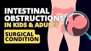 Decoding Digestive Distress - Understanding Intestinal Obstructions in Children and Adults