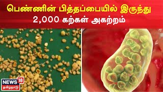 Gallstones | பெண்ணின் பித்தப்பையில் இருந்து 2,000கற்கள் அகற்றம் | Chennai | Tamil News