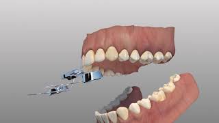 Rapid Palatal Expander