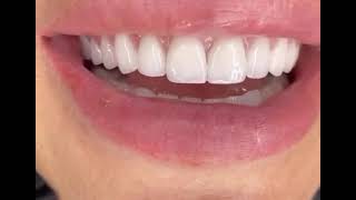 Dr. Yazan Aq. • Dantura perfecta fatete Emax Hollywood Smile (Bucuresti - Romania)