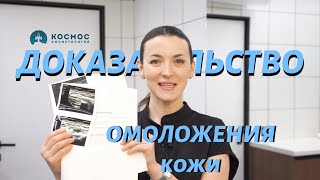 Результат ОМОЛОЖЕНИЯ КОЖИ за 3 месяца, пациентки в 51 год. #омоложениебезхирургии