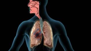 Infections of the lung –Lungs