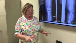 Total Knee Replacement 2 weeks after surgery