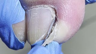 Pedicure Tutorial: A Quick Trim Process for Ingrown Nails!