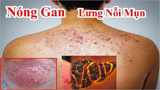 Gan Bị Nóng Nỗi Mụn Đầy Lưng / Cách Tiêu Gan Giải Độc Gan , Hạ Men Gan Nóng Trong Người Mụn Nỗi Khắp