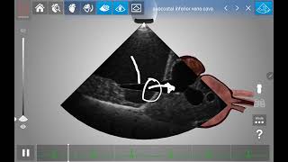 Subcostal IVC Basic Cardiac POCUS HeartWorks AR