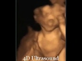 15 WEEKS GENDER REVEAL! 3D/4D BABY ULTRASOUND.. A NEW CONCEPTION ULTRASOUND STUDIO IN MA,.