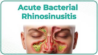 Acute Bacterial Rhinosinusitis 👃 (ABRS) : ENT Lectures