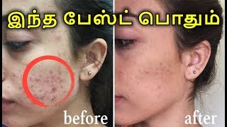 பருக்களை ஒரே இரவில் போக்கலாம் எளிய வீட்டு வைத்தியம் | Pimples Removal in Tamil | Tamil Beauty Tips