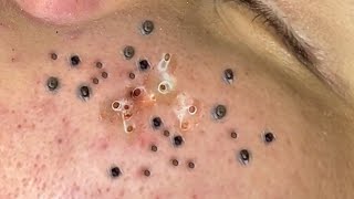 How Milia Are Satisfyingly Extracted In 2023  Acne Reomval in 2023 EP 7