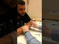 boxers fracture pin removal