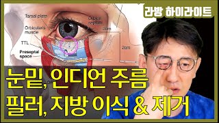 눈밑 주름, 인디언 주름(인디언 밴드) 필러, 지방 이식이나 지방 제거에 대해