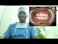 கீழ் தாடை எலும்பு முறிவு dr. a. senthil kumar mds oral u0026 maxillofacial surgeon pondicherry.