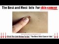 Download Skin cancer symptoms In Mp4 3Gp Full HD Video