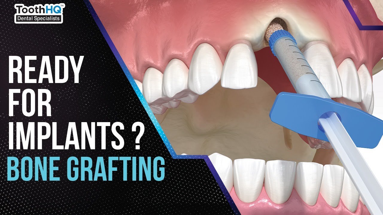 Ready For Implants Bone Grafting 101 рџџ пёџрџ Youtube