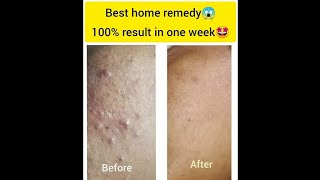 Best PIMPLE remedy|சிறந்த முகப்பரு தீர்வு|AllinAllAzhaguRaja