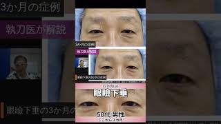 眼瞼下垂50代男性