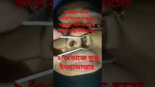 #নাকের #পলিপাসের চিকিৎসা।। #medical #nose #polipas_tv #shorts #video  🇧🇩🇧🇩🇧🇩🇧🇩🇧🇩🇧🇩🩺🩺🩺