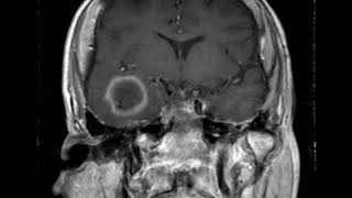 CNS C6 Cystic metastases on MRI (B)